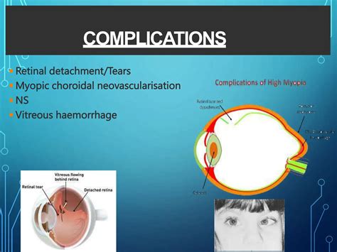 MYOPIA , basics , causes , types and treatment | PPT | Free Download