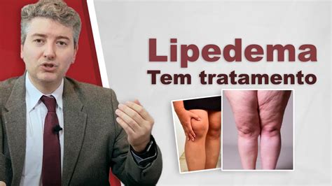 Tratamento De Lipedema Tem Tratamento Youtube