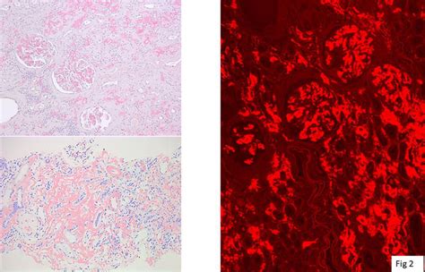 Diagnosis Of Amyloidosis Clinicopathological Advances And Challenges