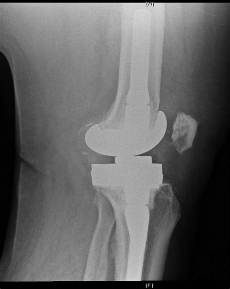 TKA Prosthesis Design - Recon - Orthobullets