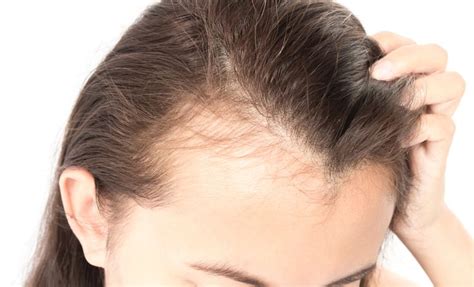 Diffuse Thinning What Is It And How To Prevent It