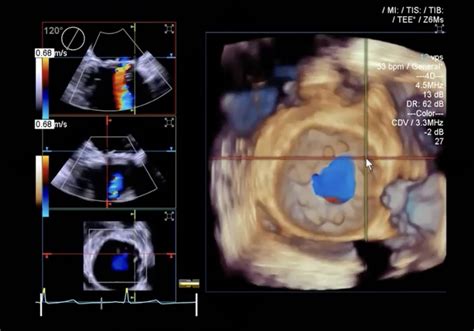 3d And 4d Trans Thoracic Echo Courses Training Semester Emse