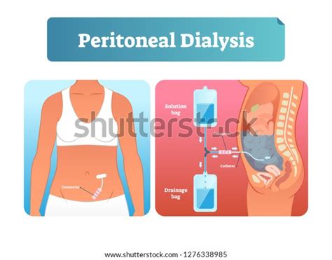 Peritoneal Dialysis Vector Illustration Labeled Scheme 스톡 벡터 로열티 프리