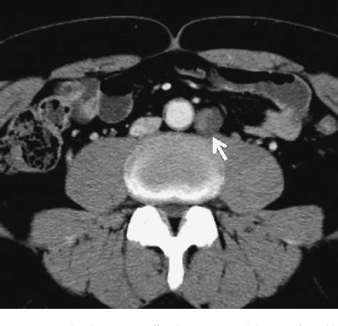 Figure From A Case Of Retroperitoneal Schwannoma Removed Surgically