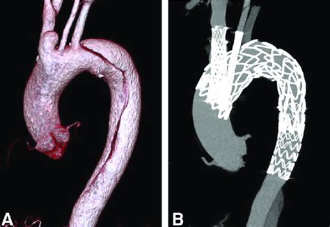 Tevar With Double Chimney Technique A Cta Showed The Aortic Download Scientific Diagram