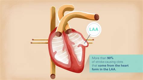 Watchman | CardioVascular Afib Procedure