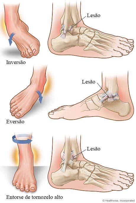 Entorse de Tornozelo Ortolife Ortopedia Técnica