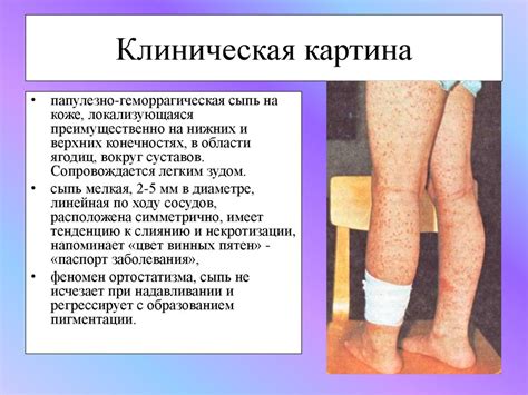 Геморрагический васкулит, болезнь Шенлейна-Геноха - презентация онлайн