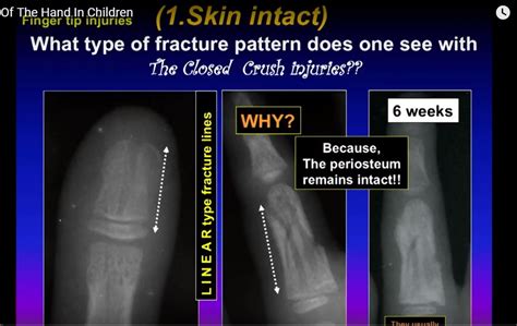 Hand fractures in Children — OrthopaedicPrinciples.com