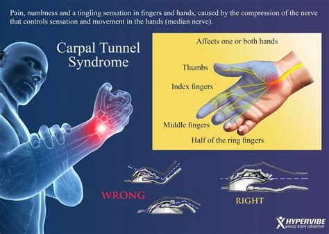 Carpal Tunnel Syndrome Carpal Tunnel Syndrome Infographic Health