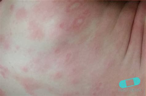 Online Dermatology Erythema Multiforme