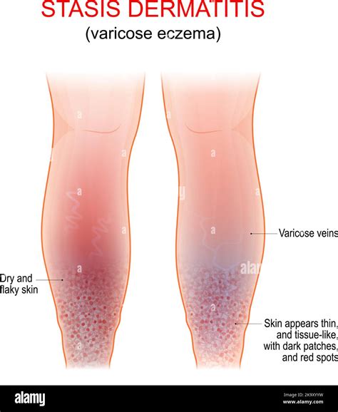 Varicose Eczema Symptoms Of Venous Gravitational Or Stasis Dermatitis