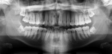 Real Time Dental Caries Detection From X Ray Images Intel Devmesh