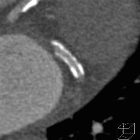 Coronary stent. Coronary CT images of the mid left circumflex artery of ...