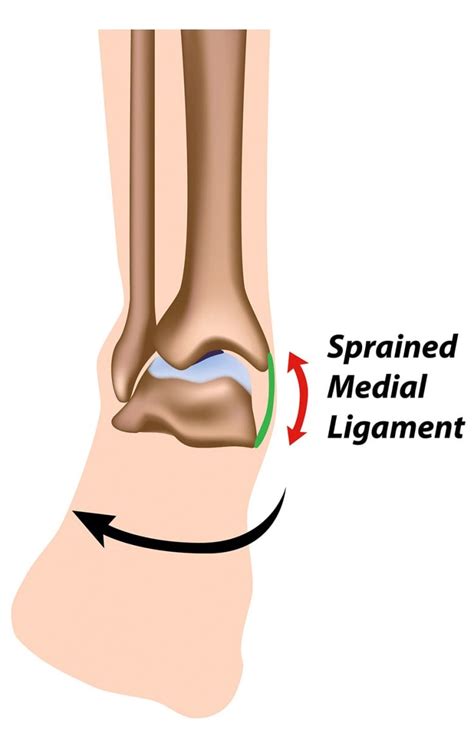 Grade 2 Ligament Sprain - Sprained Ankle Orthoinfo Aaos / The ligament ...