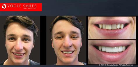 Straighten Overlapping Crooked Crowded Teeth In Melbourne