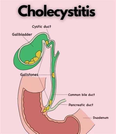 Cholecystitis Medizzy