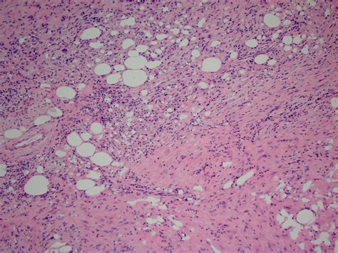 Pathology Outlines Sclerosing Mesenteritis