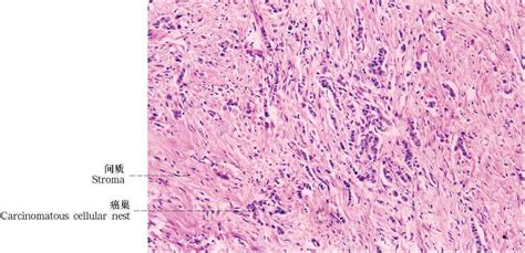 277乳腺浸润性导管癌硬癌 病理学图谱 医学