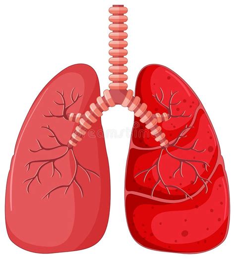 Longdiagram Met Longontsteking Vector Illustratie Illustration Of