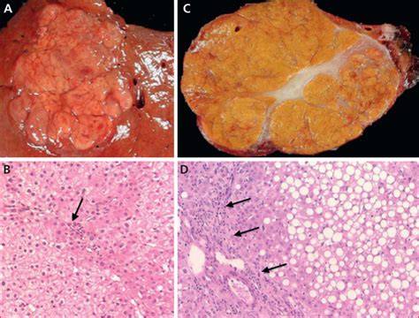 JLE Hépato Gastro Oncologie Digestive Tumeurs bénignes du foie