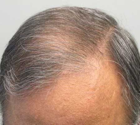 Mens Hair Loss Treatment Dr Health Clinic Homepage