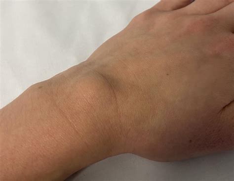 Does Massaging A Ganglion Cyst Help At Ron Mcdonald Blog