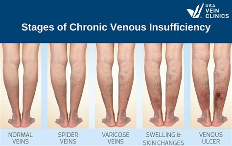 The Stages Of Chronic Venous Insufficiency CVI