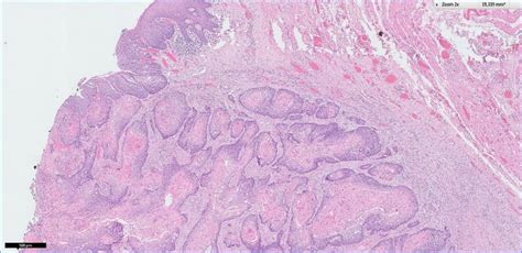 Squamous Cell Carcinoma In The Oral Mucosa Of The Mandible Nest Of