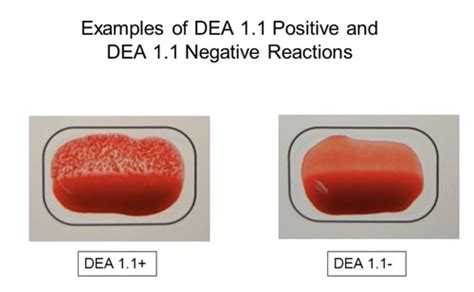 Transfusion Reactions Flashcards Quizlet