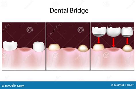 Dental bridge procedure stock vector. Illustration of disease - 26546504