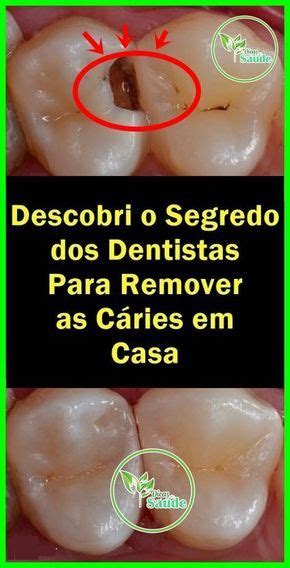 7 Receitas Para Eliminar As Cáries Dentária Sem Ir Ao Dentista Cárie