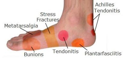 Foot Pain Causes