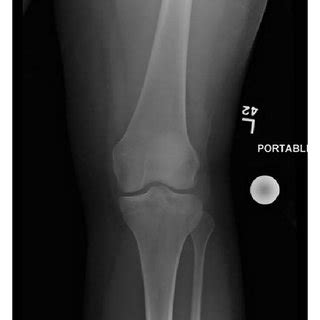 AP And Lateral Plain Radiographs Of The Left Knee Showing A