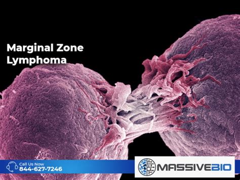 Marginal Zone Lymphoma - MZL Subtypes - Massive Bio