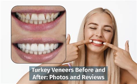 Turkey Veneers Before and After Photos - MedicaSmile