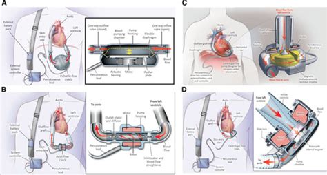 Device Therapy And Arrhythmia Management In Left Ventricular Assist