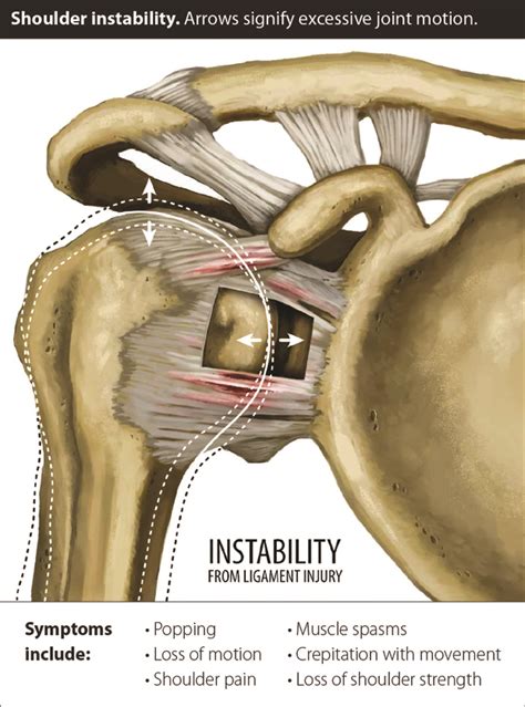 Labral Tears And Rotator Cuff Injuries Regenerative Treatments For