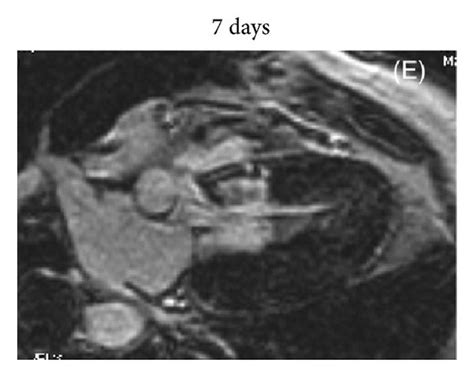 Cardiac Magnetic Resonance Imaging Before And After Septal Reduction