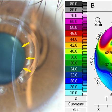 Corneal Iron Line Which Is Formed After Intrastromal Ring Insertion