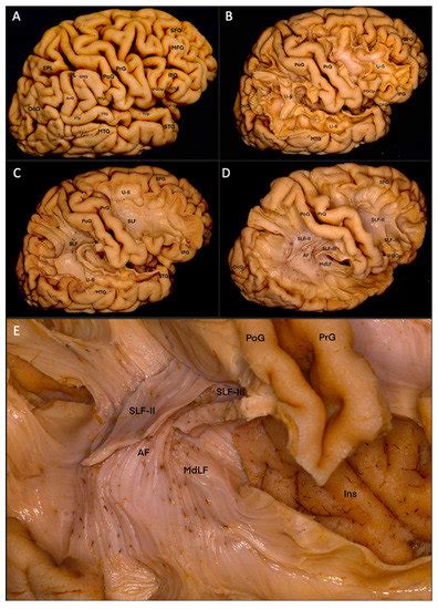 Brain Sciences Free Full Text Supramarginal Gyrus And Angular Gyrus Subcortical Connections