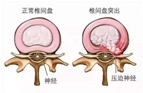 腰椎間盤突出症毀了多少人的腰，做完手術就好了嗎？現實很殘酷！ 每日頭條