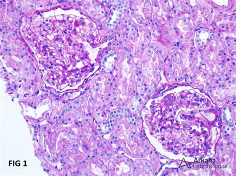 IgA Nephropathy | Teaching Points | Arkana Laboratories