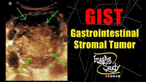 Gastrointestinal Stromal Tumor Gist Ultrasound Doppler Case