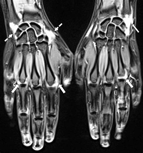 Bilateral Mr Imaging Of The Hand And Wrist In Early And Very Early