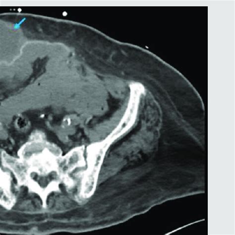 Initial Computed Tomography Ct Of The Abdomen And Pelvis Showing Download Scientific Diagram