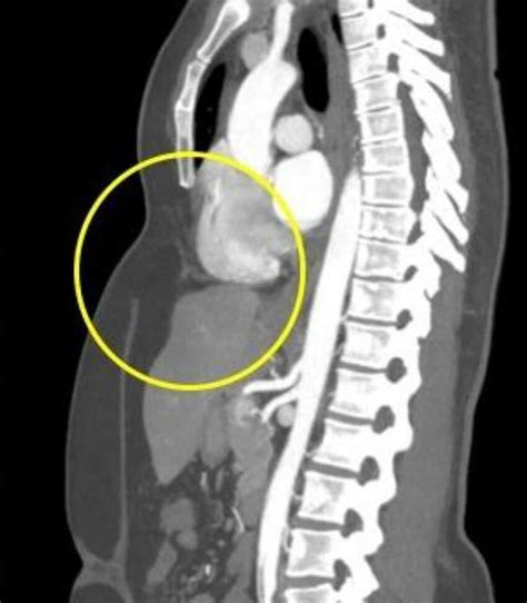 preoperative image. transverse scar is evident in upper abdomen/lower ...