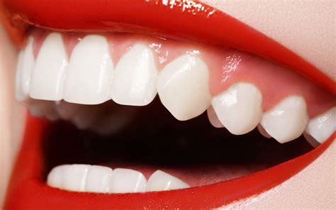 Fang Implants A Guide By Cosmetic Dentist Royal Dental Clinics Blog