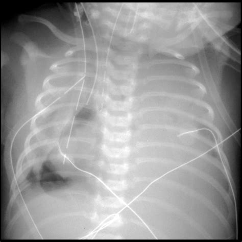 Pediatric Extracorporeal Membrane Oxygenation Pediatric Radiology