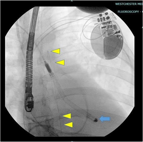 Escalation From Intra Aortic Balloon Pump To Axillary Impella 5 5